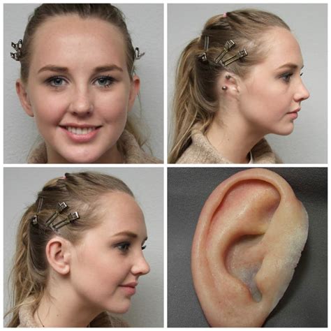 bag of fake ears|ear prosthesis near me.